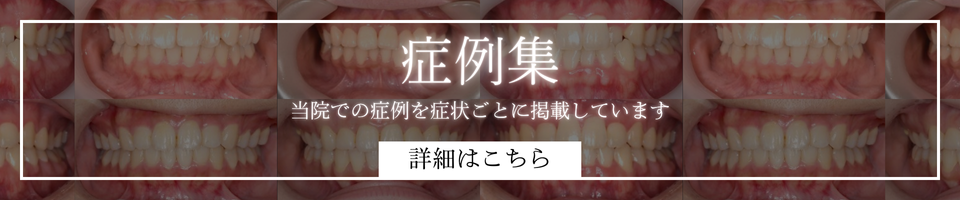 マウスピース型矯正